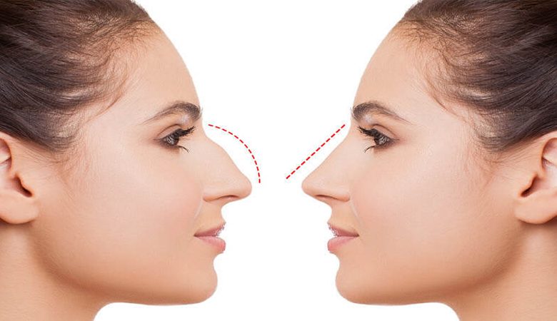 The Perfect Fit: How Nose Shape Impacts Facial Proportions