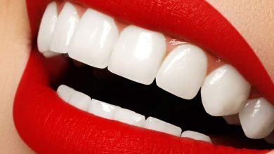 Best Veneers in Dubai