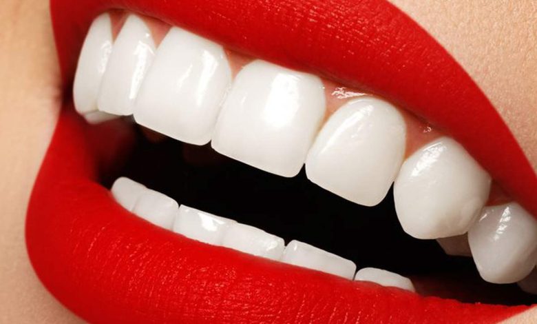 Best Veneers in Dubai