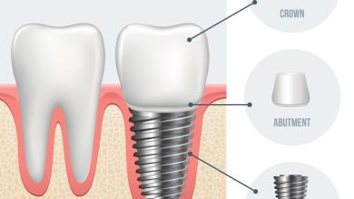 Dental Implants Cost in Dubai
