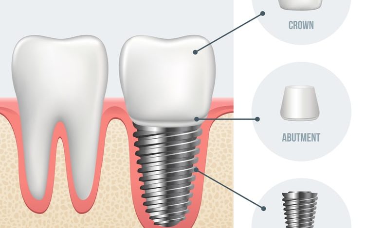 Dental Implants Cost in Dubai