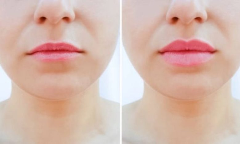Why Are Lip Filler A Popular Choice For Enhancing Lip Aesthetics?