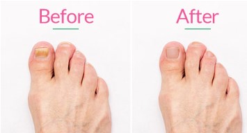 Where to Get the Best Toenail Laser Treatment in Scottsdale