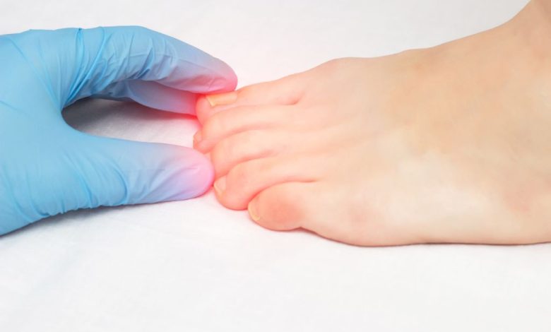 Where to Get Surgery for Ingrown Toenail in AZ