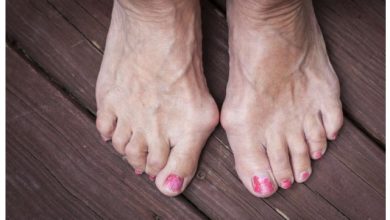 What Is Bunion Surgery A Comprehensive Guide to the Procedure and Benefits