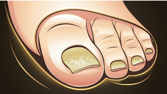 When Should You Expect to See That Toenail Fungus Is Dying?